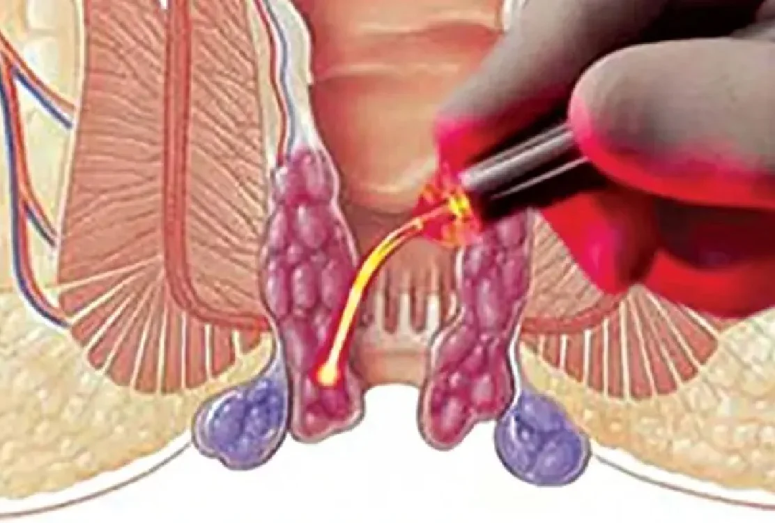 Cost and recovery of hemorrhoid laser in Tehran